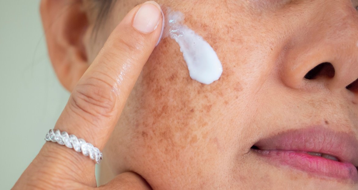 Tratamento para melasma